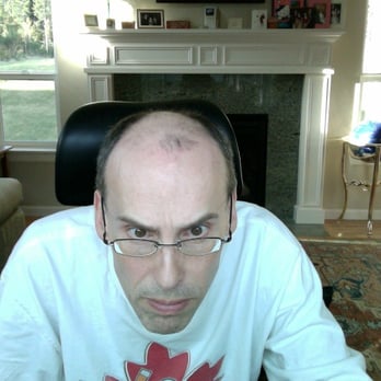 Advanced Hair Restoration - Before I was introduced to Advanced Hair Restoration - Hair Loss Centers Near Me - Bellevue, Washington