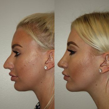 Boris M. Ackerman, MD - Rhinoplasty before and after results - Cosmetic Surgeons Near Me - Newport Beach, California Boris M. Ackerman, MD - Rhinoplasty before and after results - Cosmetic Surgeons Near Me - Newport Beach, California