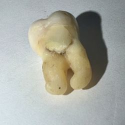 Randolph E Miller, DMD - Right rear molar with Dr. Miller's bad filling below the gumline