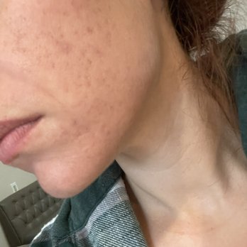 Mikkasa - October 2020 - Skin Care Near Me - Scottsdale, Arizona
