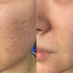 Microneedling with Exosome