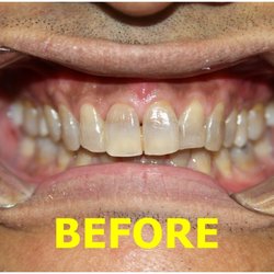Precilyn B Silvestre, DDS - BEFORE