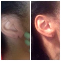 Berman Cosmetic Surgery & Skin Care Center - Before and after my torn earlobe repair. Only 1 week post-repair, so it's still healing but looks amazing!