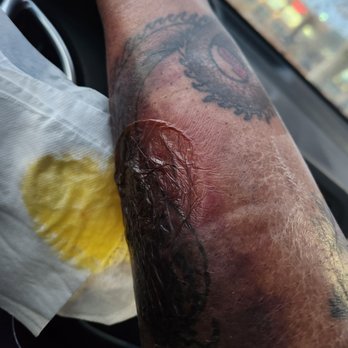 LaserAway - The image depicts a person's arm with multiple tattoos, featuring a large, fresh wound that is red and swollen. The wound is covered with a transparent plastic wrap, likely for protection and healing. The background suggests the photo was taken inside a vehicle, with part of a car interior visible. The arm appears to be resting on a surface, and there is a tissue with some yellowish substance nearby. - Tattoo Removal Near Me - Albuquerque, New Mexico