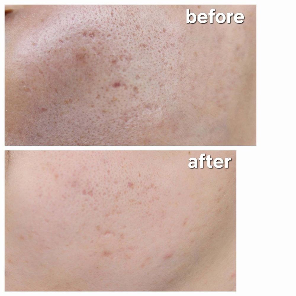 Microneedling by Vicky - Skin Care Near Me - Folsom, California Microneedling by Vicky - Skin Care Near Me - Folsom, California