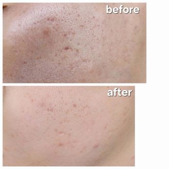 Microneedling by Vicky - Skin Care Near Me - Folsom, California Microneedling by Vicky - Skin Care Near Me - Folsom, California