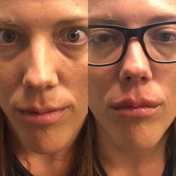 Timeless Aesthetic Injections
