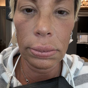 Hales Aesthetic - Face has collapsed due to improper dize n placement of teeth - Cosmetic Dentists Near Me - Newport Beach, California