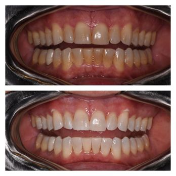 Studio Dental - Before / After In-Office Professional Teeth Whitening Service - General Dentistry Near Me - San Francisco, California Studio Dental - Before / After In-Office Professional Teeth Whitening Service - General Dentistry Near Me - San Francisco, California