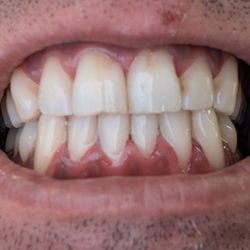 Centre Dental Office - After natural cleaning. P.s. I'ma heavy smoker and I drink too many coffee