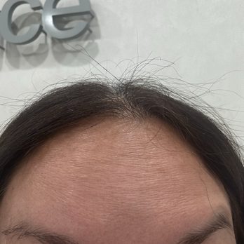 Not Just Lips - Forehead still has lines - Aestheticians Near Me - New York, New York Not Just Lips - Forehead still has lines - Aestheticians Near Me - New York, New York