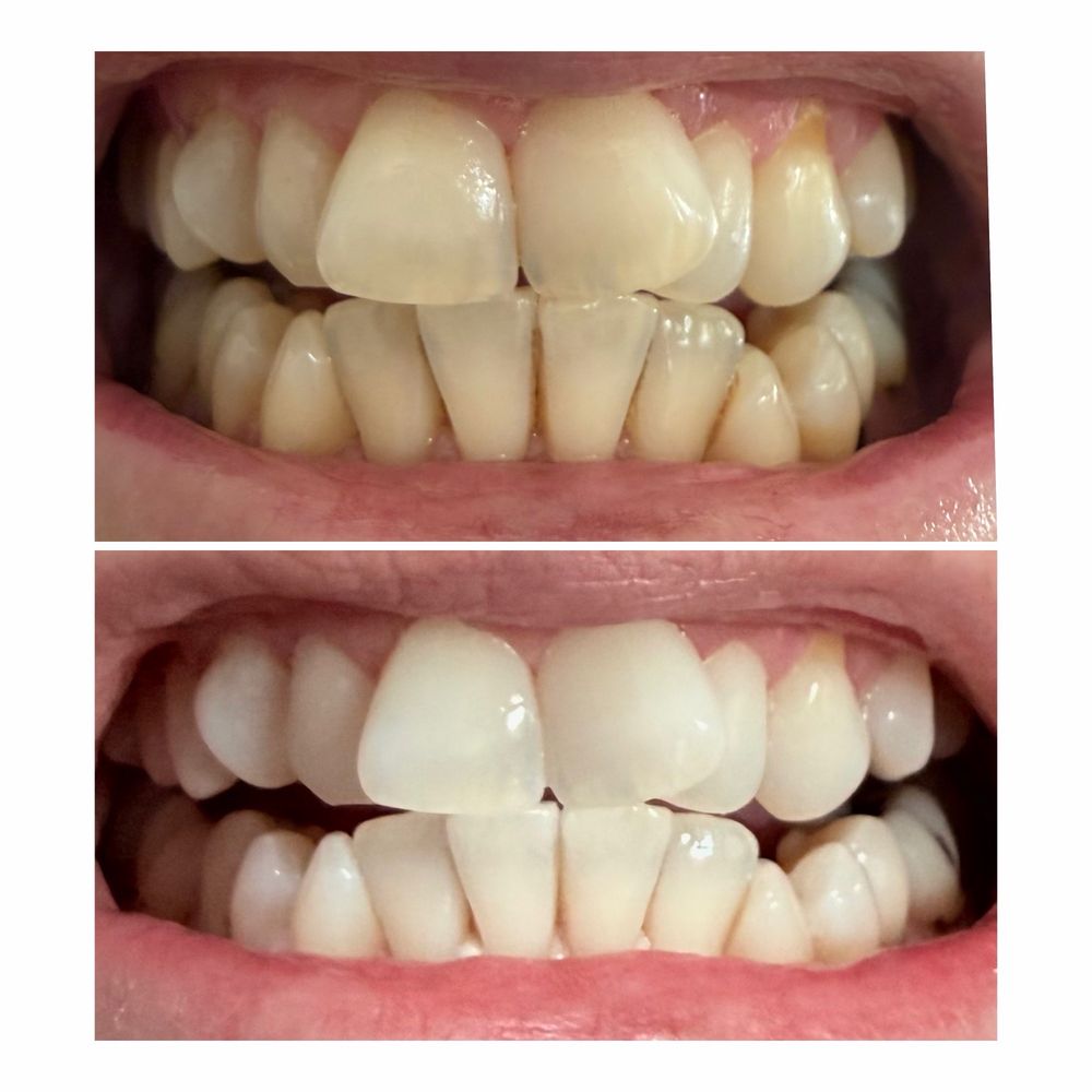 Opalite Collective - Top photo before / Bottom photo after - Teeth Whitening Near Me Opalite Collective - Top photo before / Bottom photo after - Teeth Whitening Near Me