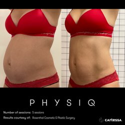 Vitality Wellness Med Spa - PhysiQ Before and Afters in Fort Worth, Texas at Vitality Wellness Med Spa