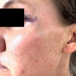 Revive Med Spa - Carmel Valley - Bruising day after treatment.