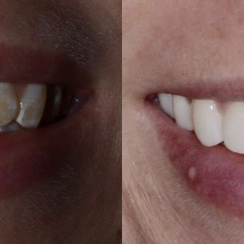 Artistic Expressions Dentistry - Before & After Results of Artistic Expressions Dentistry | Doylestown, PA - Cosmetic Dentists Near Me - Doylestown, Pennsylvania