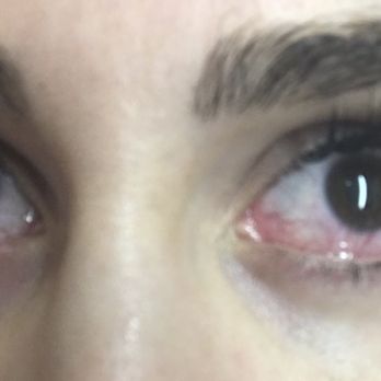 Luxy Lashes & Skin - Both eyes infected day after lashes - Skin Care Near Me - Houston, Texas