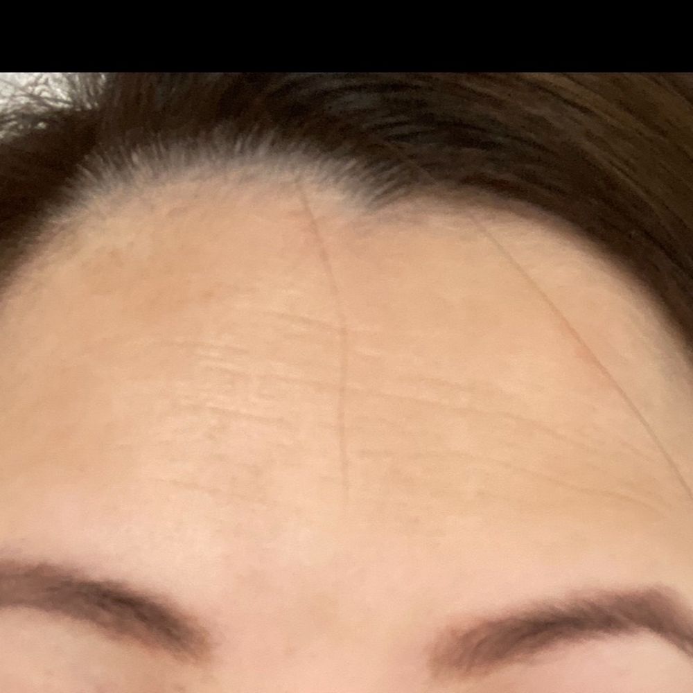 Neuskin Aesthetics - This was my "before" u can see the visible lines on forehead - Aestheticians Near Me - Irving, Texas Neuskin Aesthetics - This was my "before" u can see the visible lines on forehead - Aestheticians Near Me - Irving, Texas