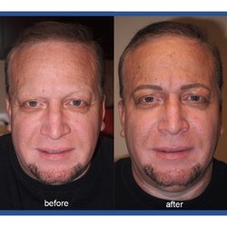 Best Permanent Makeup By Jeffery Lyle Segal - Male alopecia clients can also have natural looking eyebrows with microblading.
