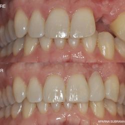Aparna Subramanian - ALL PORCELAIN THREE UNIT BRIDGE