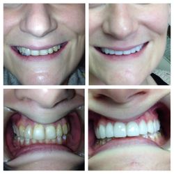 Callas Yvonne DMD - Natural looking veneers to cover up staining.