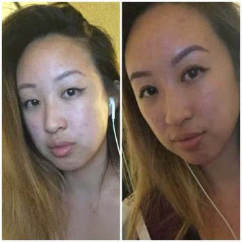 John Park MD Plastic Surgery - Before & 1.5 month after - Cosmetic Surgeons Near Me - Newport Beach, California John Park MD Plastic Surgery - Before & 1.5 month after - Cosmetic Surgeons Near Me - Newport Beach, California