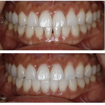 Goldberg Dental Group - Triangle gap closure in bottom teeth - Cosmetic Dentists Near Me - San Diego, California