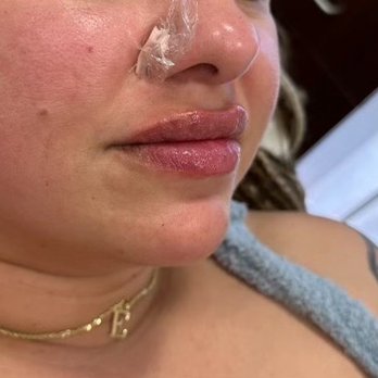 Dermaesthetics - Mole removal service performed by Elle 2/12/2024 - Medical Spas Near Me - Roseville, California Dermaesthetics - Mole removal service performed by Elle 2/12/2024 - Medical Spas Near Me - Roseville, California