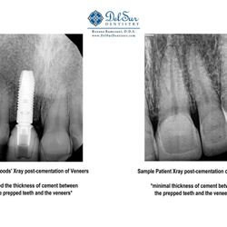 Carlsbad Village Dentistry - 1 comparison photo from one of my 2nd opinions. My veneer placement looks nothing like the sample patient.