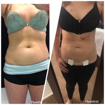 Smith Plastic Surgery - Pre abdomen and waist liposuction and two weeks post - Cosmetic Surgeons Near Me - Las Vegas, Nevada Smith Plastic Surgery - Pre abdomen and waist liposuction and two weeks post - Cosmetic Surgeons Near Me - Las Vegas, Nevada