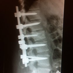 Intuitive Bodywork - This is my back and my hardware that Erika has been working with. It looks bad and it is! She does magic!