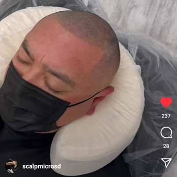 Scalp Micro SD - My after photo - Permanent Makeup Near Me - San Diego, California