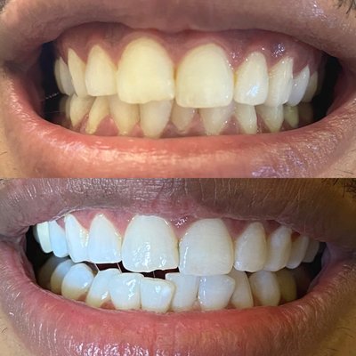 Teeth Whitening - 50% Off First Time Clients! Traveling Option Available.
Professional strength products only, maximum strength whitening developed for dentists. We use gum protect barrier gel - as a professional would. Professional LED blue light and included in the package an upper & bottom teeth tray with a syringe of re-mineralizing gel to rejuvenate, hydrate, and strengthen your teeth. Result just after one visit (3 rounds of 20mins sessions). Yes we are certified to do this procedure for you professionally. You will love your smiles even more! Total visit is an hour and half. Teeth Whitening - 50% Off First Time Clients! Traveling Option Available.
Professional strength products only, maximum strength whitening developed for dentists. We use gum protect barrier gel - as a professional would. Professional LED blue light and included in the package an upper & bottom teeth tray with a syringe of re-mineralizing gel to rejuvenate, hydrate, and strengthen your teeth. Result just after one visit (3 rounds of 20mins sessions). Yes we are certified to do this procedure for you professionally. You will love your smiles even more! Total visit is an hour and half.