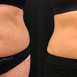 Advanced Body Sculpting and Medspa - Results!!