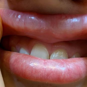 Elements Dental Spa & Aesthetics - Lip filler - Cosmetic Dentists Near Me - Baton Rouge, Louisiana