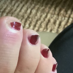 Toenails cut way too short on sides