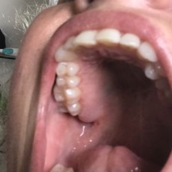 Avila´s Dental Group - Healthy pink gum and normal, not visible extraction hole that took 15 mins to extract and needed NO STITCHES.