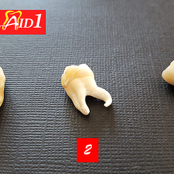 Dental Aid 1 - Exacted Wisdom tooth with curved root