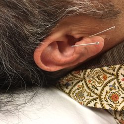 Nature's Balance Acupuncture - Ear needles