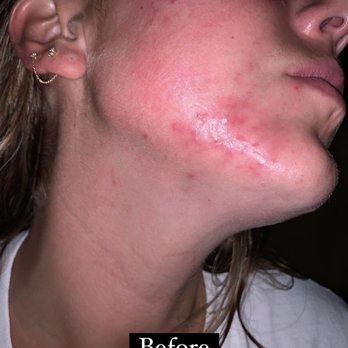 Source - Before treatment began - Acupuncture Near Me - San Diego, California Source - Before treatment began - Acupuncture Near Me - San Diego, California