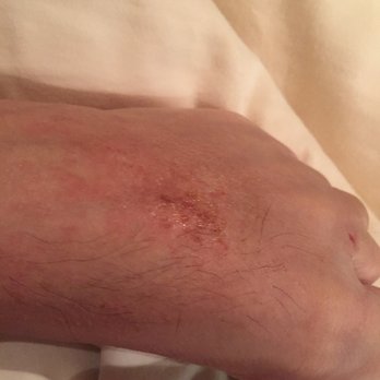Amado Amado - Another photo of the blisters left after a $50 men's pedi!! - Hair Salons Near Me - San Juan, Puerto Rico