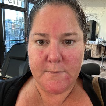 Reflections Med Spa and Salon - Week 1 - Dr. Platon Cold Plasma Gun - Medical Spas Near Me - Los Alamitos, California Reflections Med Spa and Salon - Week 1 - Dr. Platon Cold Plasma Gun - Medical Spas Near Me - Los Alamitos, California