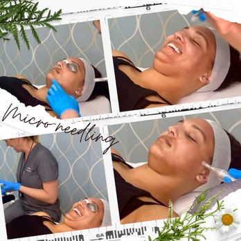 Luminous Laser - Micro needling treatment - Laser Hair Removal Near Me - Scottsdale, Arizona Luminous Laser - Micro needling treatment - Laser Hair Removal Near Me - Scottsdale, Arizona