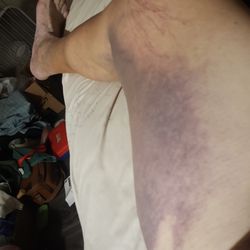 The inside of my leg from my scrotum almost to my knee halfway around my leg I hope you can help