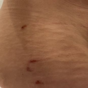 Los Robles Hospital - Surgical tape removal wounds - Hospitals Near Me - Thousand Oaks, California