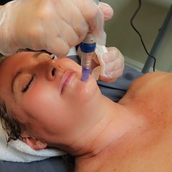 Ultra Body Contour - Microneedling - Body Contouring Near Me - Midvale, Utah Ultra Body Contour - Microneedling - Body Contouring Near Me - Midvale, Utah