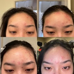 Christie Carroll,MD - Acne progress
