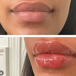 New Journey Medical & Aesthetics - See the stunning before-and-after of our patient's lipo injections. Fillers enhance definition and volume for a flawless finish!