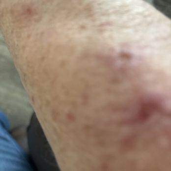 Palm Beach Tan - Skin cancer on my right arm. - Skin Care Near Me - Windsor, California Palm Beach Tan - Skin cancer on my right arm. - Skin Care Near Me - Windsor, California