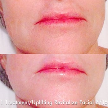 Ageless Skin Studio - Actual Facial Client of Denise B at Ageless Skin Studio Ventura CA - Skin Care Near Me - Ventura, California