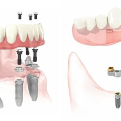 Donald J Johnson, DMD - All-on-4 implants